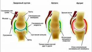 остеоартроз артроз коленного сустава